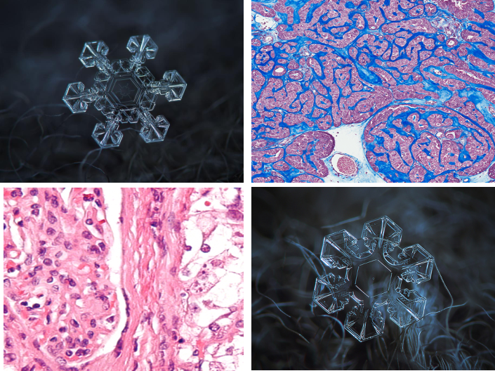 Study shows that Metastatic cancers are “malignant snowflakes,” each having unique genomic portfolios