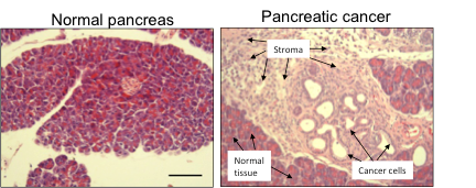 pancreatic cancer stroma