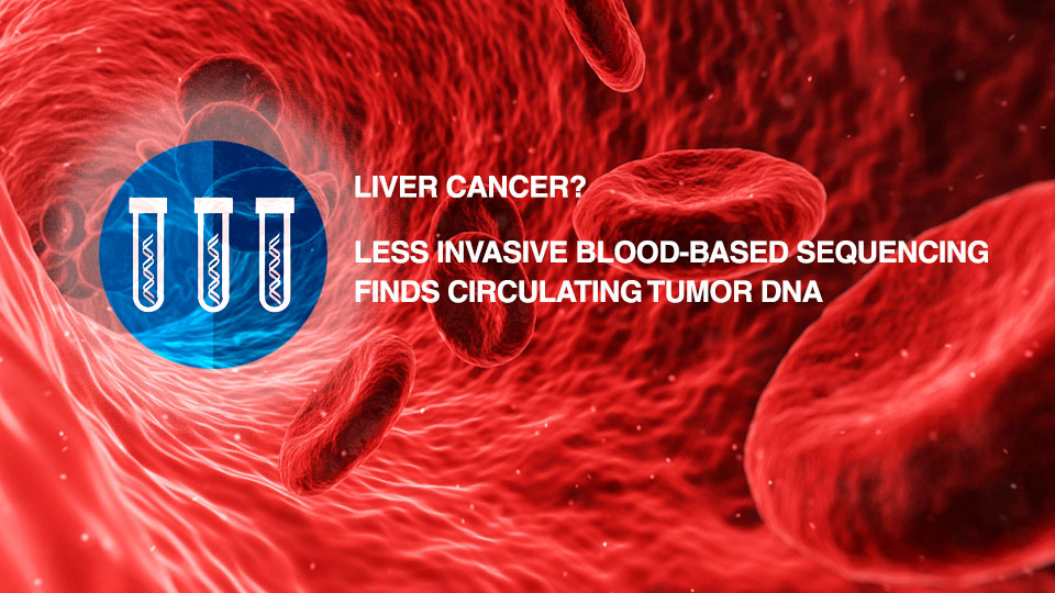 Blood-based Tumor DNA Can Lead to New Personalized Liver Cancer Treatment Decisions